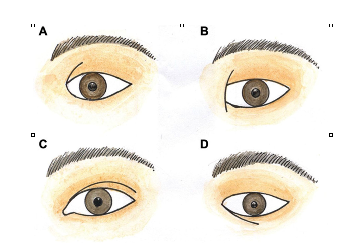 epicanthal folds vs normal