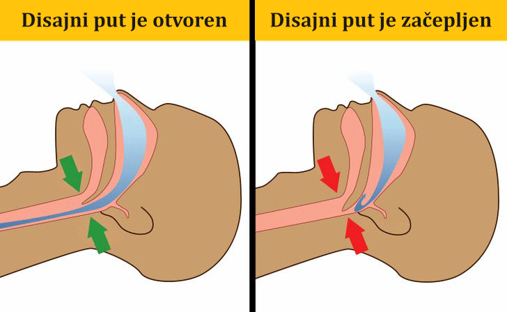 Apneja u spavanju