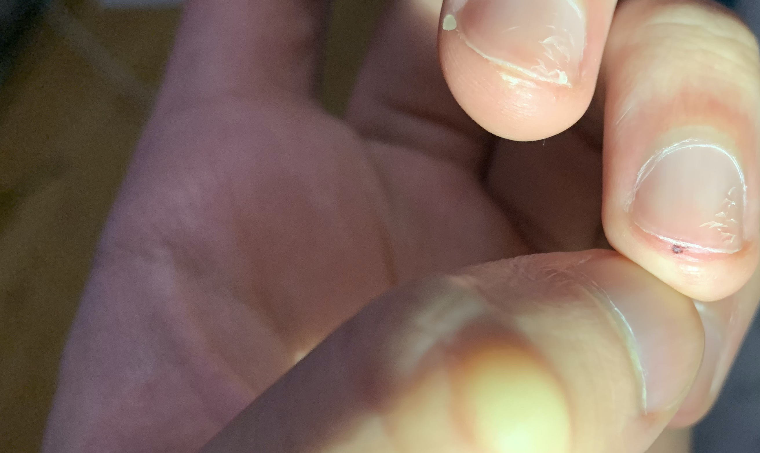 What is this black spot under my nail medical_advice