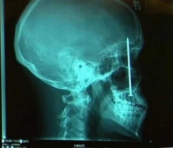 X-RAYS........... VFsospVw_o