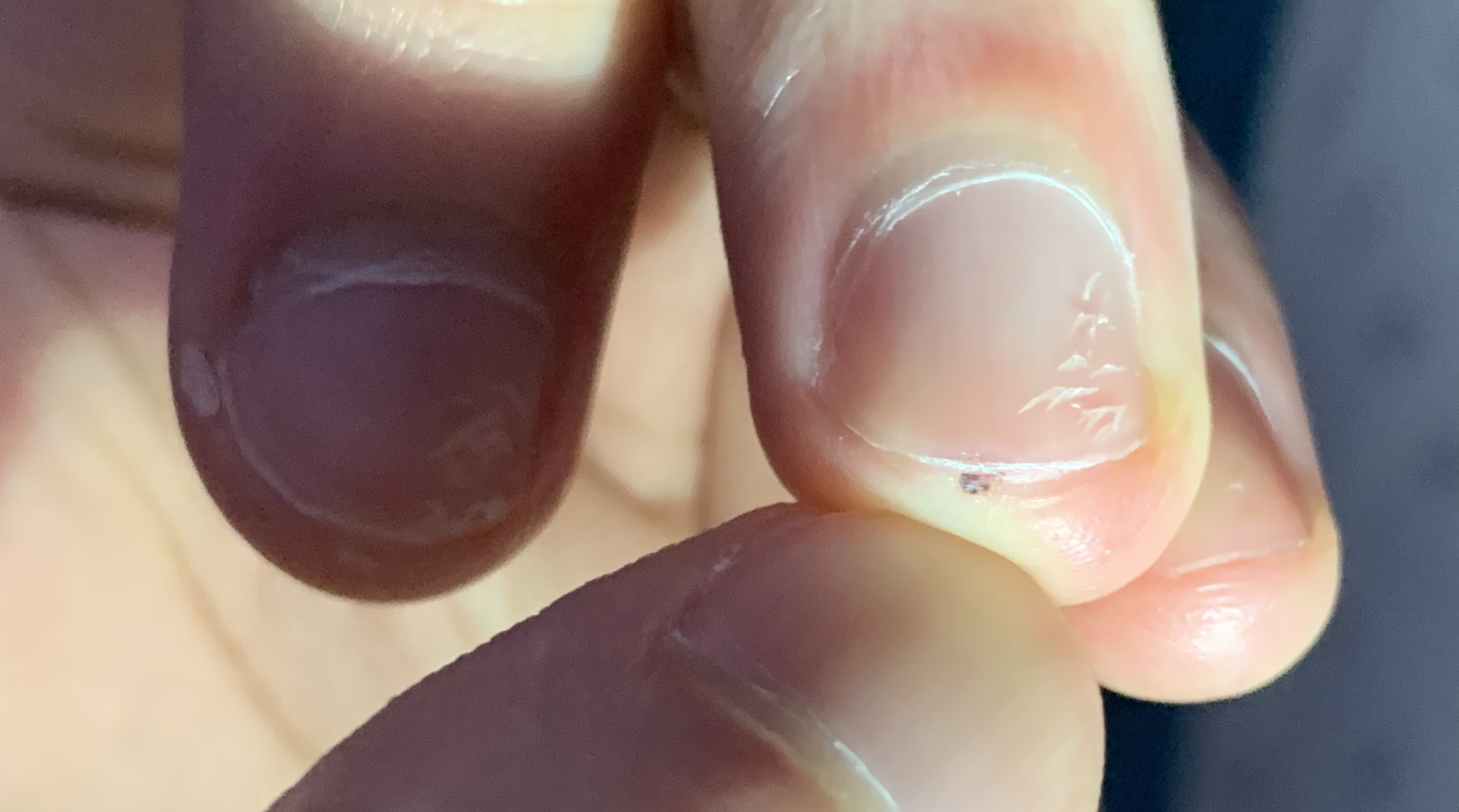 what-is-this-black-spot-under-my-nail-medical-advice